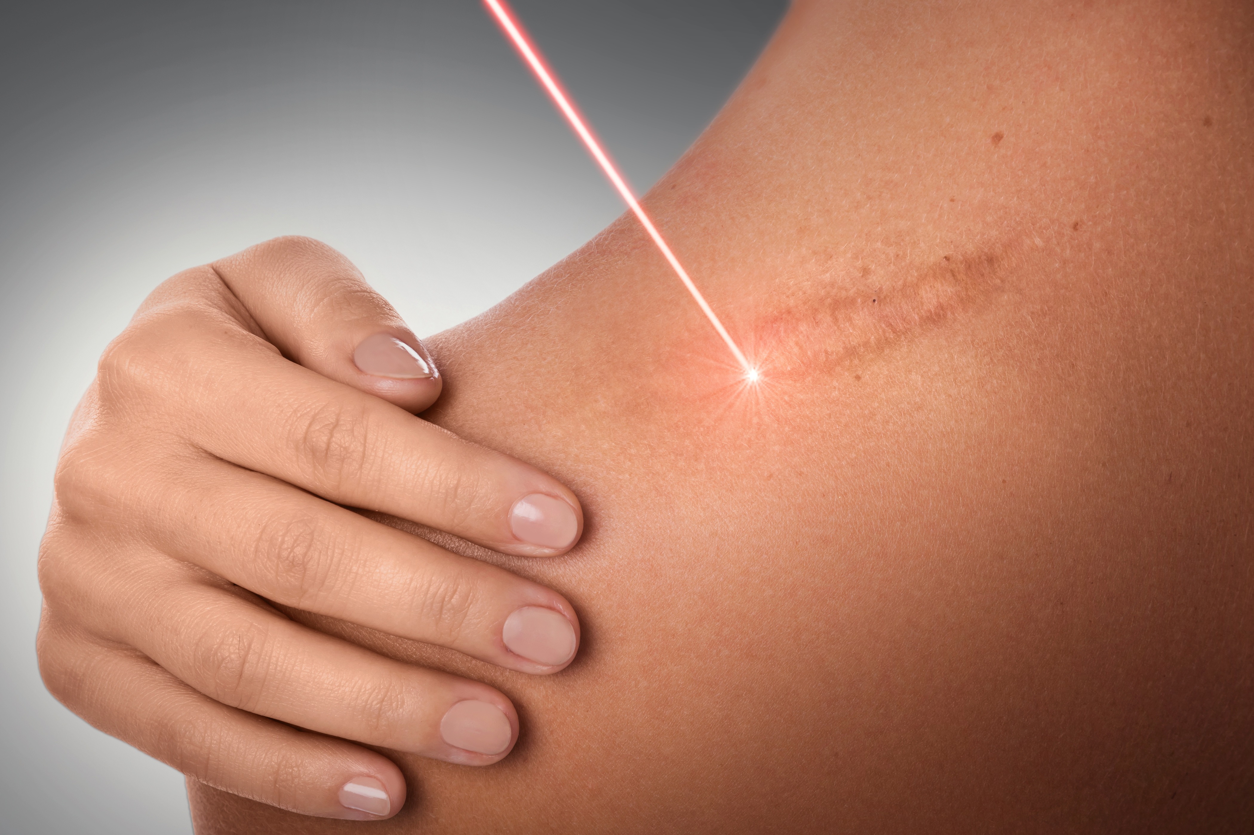 Types of Scars and Laser Skin Treatments and More Treatment Options